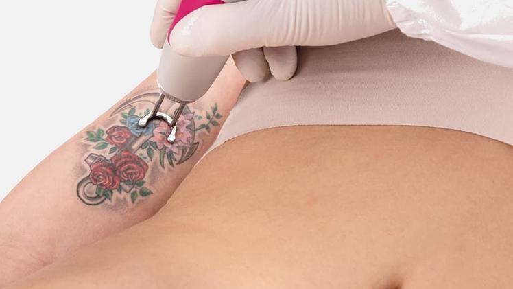 L’apparecchio laser ideato a Vicenza per riuscire a cancellare i tatuaggi non più graditi