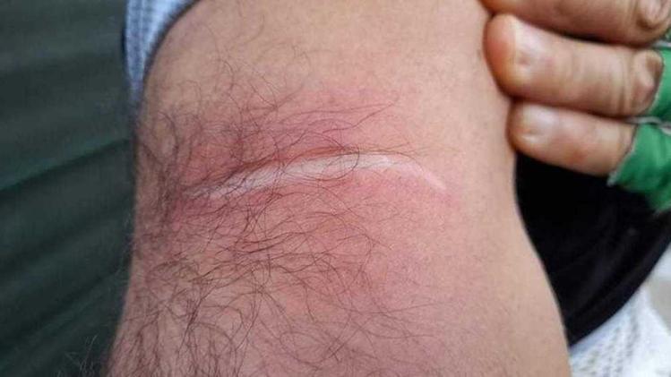 Il segno   Lasciato sul braccio del ciclista ferito dal filo di ferro teso sulla strada di campagna